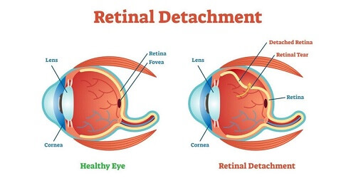 Ablasio Retina