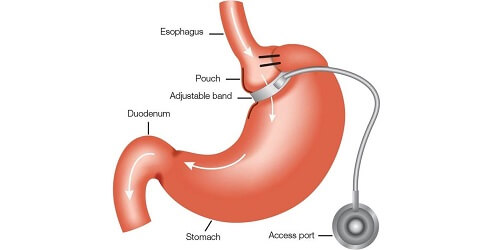 Adjustable Gastric Banding