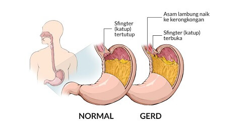 Asam Lambung