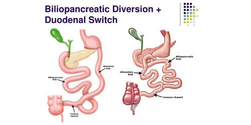 Biliopancreatic Diversion with Duodenal Switch