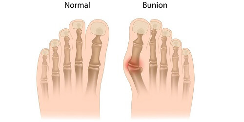 Bunion