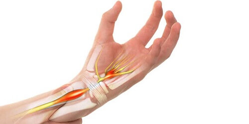 Carpal Tunnel Syndrome