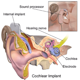 Cochlear Implant