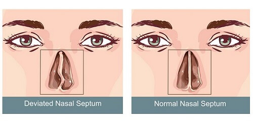 Deviasi Septum