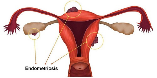 Endometriosis