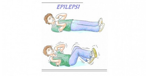 Epilepsi Pada Anak