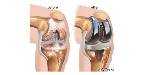 Operasi Ganti Sendi Lutut