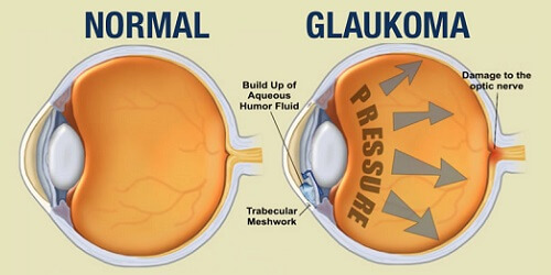 Glaukoma