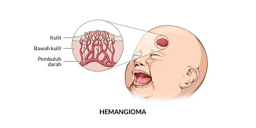 Hemangioma