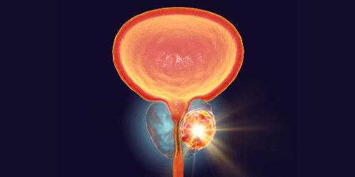 Terapi PSMA Kanker Prostat