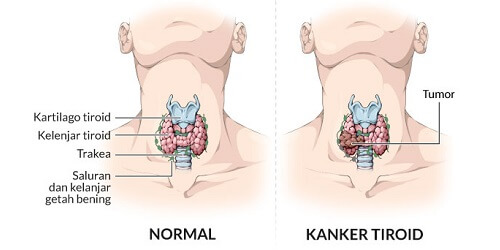 Kanker Tiroid