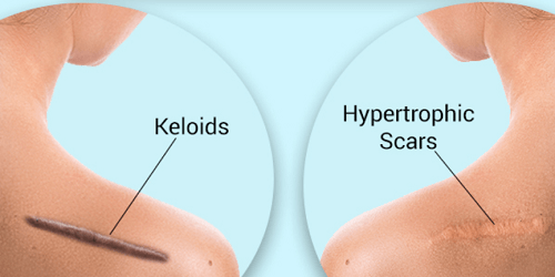 Keloid