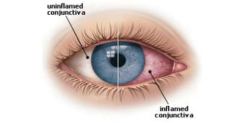 Berobat Keratokonjungtivitis di Malaysia