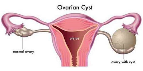 Kista Ovarium