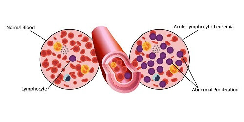 Leukemia Myeloid Akut (AML)