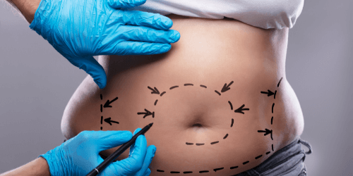 Liposuction