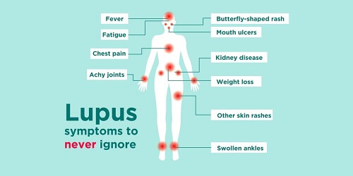 Lupus