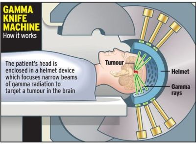 Meningioma dgn Gamma Knife