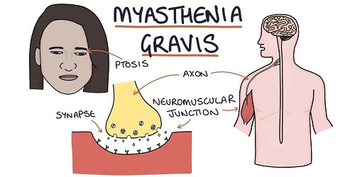 Myasthenia Gravis