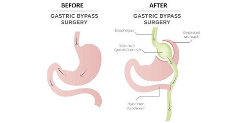 Operasi Bariatik Bypass