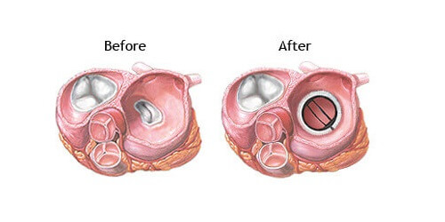Operasi Katup Jantung