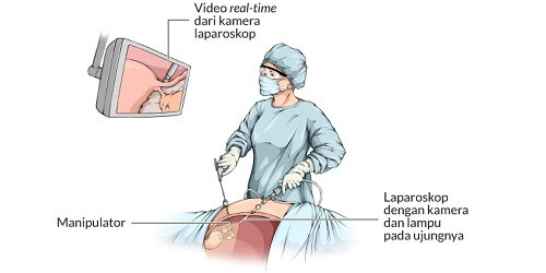 Laparoscopic Sleeve Gastrectomy