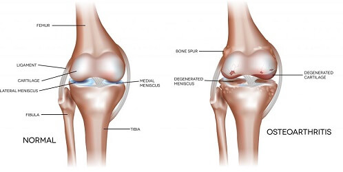 Osteoarthritis