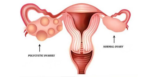 PCOS