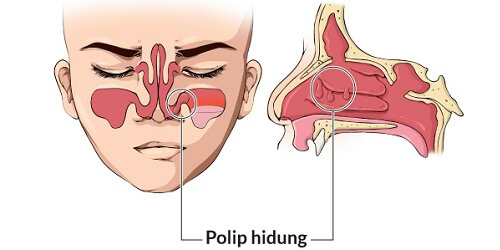 Polip Hidung