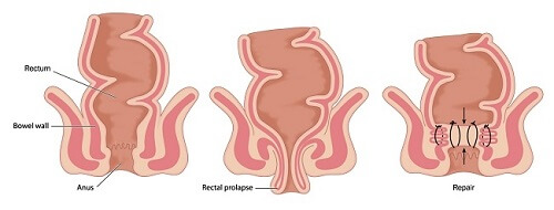 Prolaps Uteri