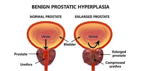 Prostat