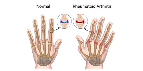 Rheumatoid arthritis adalah