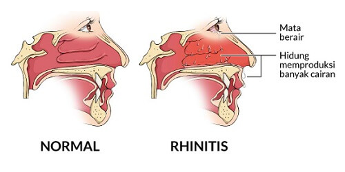 Rinitis Alergi