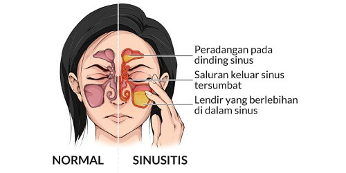 Sinusitis