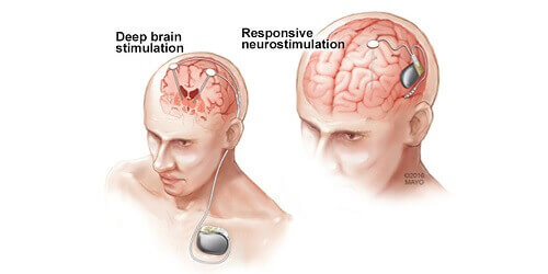 Stimulasi Otak Dalam (DBS)