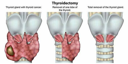 Thyroidectomy