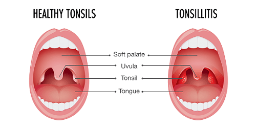 Tonsilitis