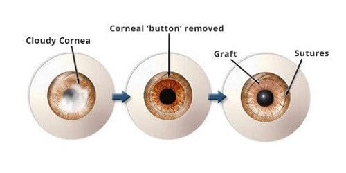 Transplantasi Kornea