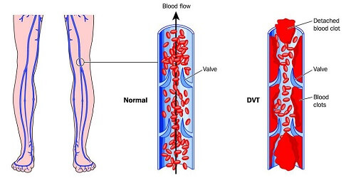 Trombosis Vena Dalam