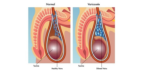 Varikokel