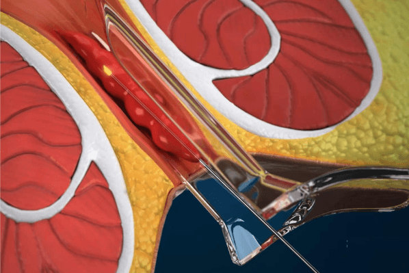 Laser Hemorrhoidoplasty (LHP)