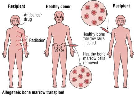 Fakta Tentang Bone Marrow Transplant (Transplantasi Sumsum Tulang)