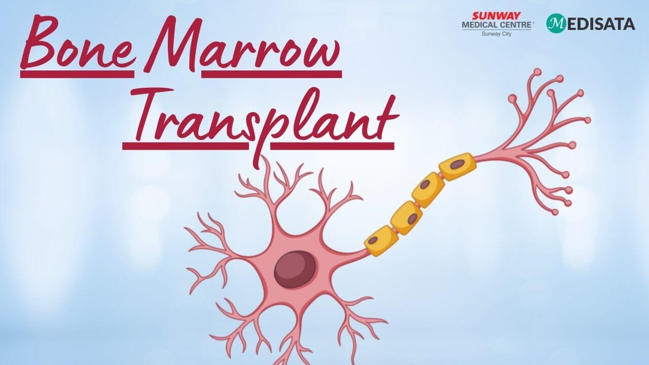 Fakta Tentang Bone Marrow Transplant (Transplantasi Sumsum Tulang) 